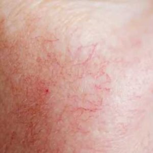 laser for broken capillaries