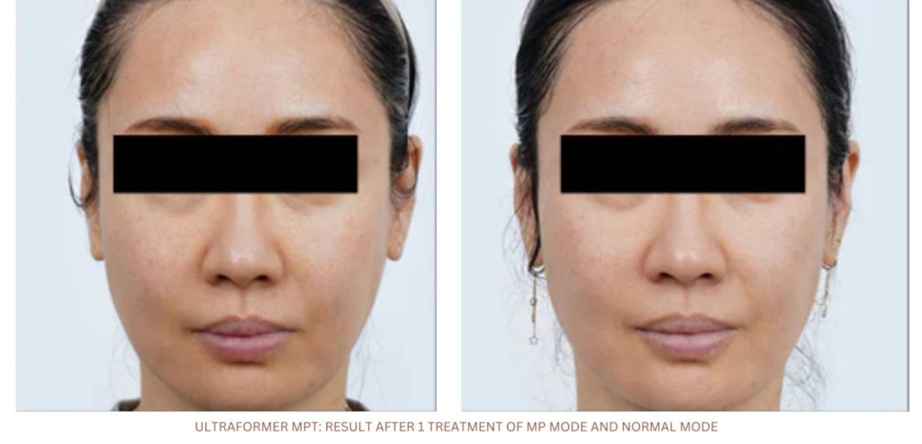 Before and after comparison of a woman's face from an Ultraformer MPT session, showing visibly tighter and smoother skin post-treatment, illustrating the efficacy of the Ultraformer MPT technology