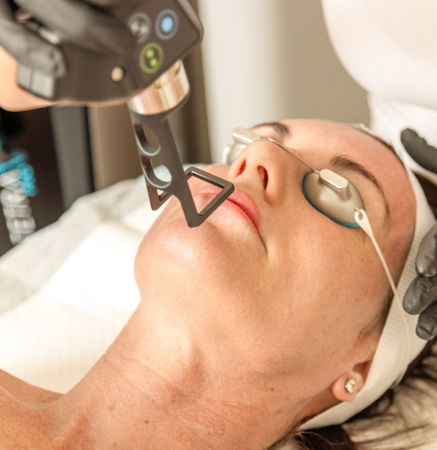 CO2 Laser Resurfacing at Ascension Clinic in Brisbane