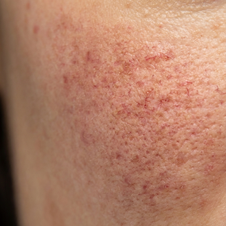 up close skin photo of flushing from rosacea