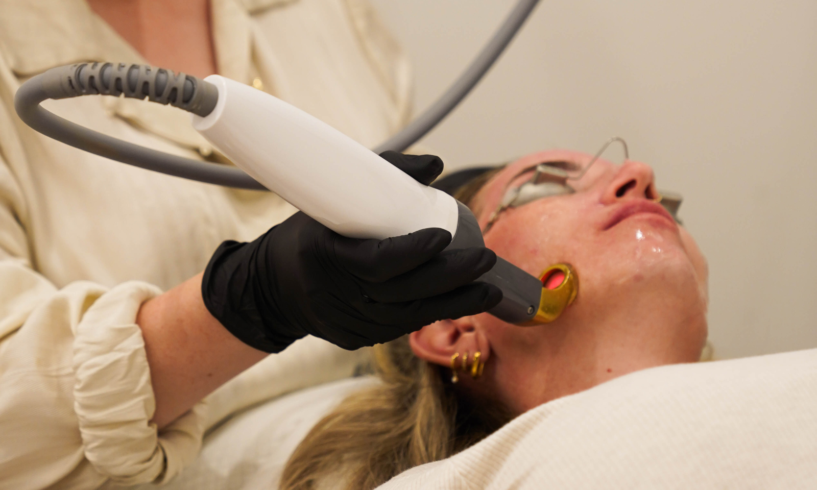 Person receiving a facial laser procedure in a clinical setting, sometimes included in educational discussions of what is rosacea.
